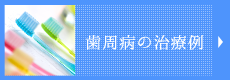 歯周病の治療例